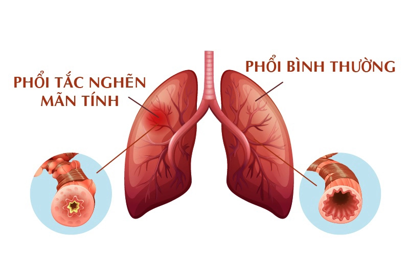 Hình ảnh phổi trong bệnh lý viêm phổi tắc nghẽn mạn tính.webp